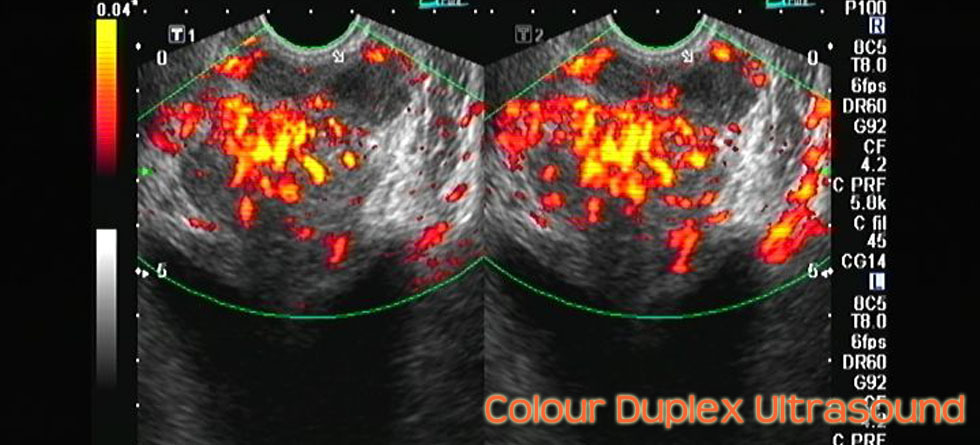 Duplex Ultrasound